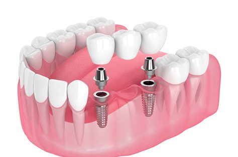 Diagram showing an implant bridge in Indianapolis