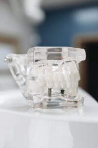 Dental model of implant-supported bridge