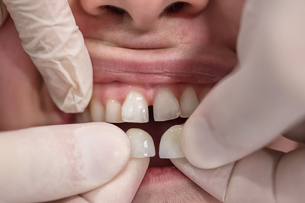 dentist holding veneers up to patient’s teeth 